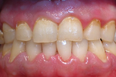 tẩy trắng răng khi bị nha chu