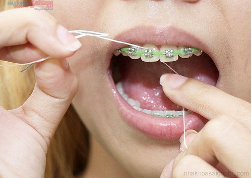 Những vật dụng cần thiết để chăm sóc răng miệng khi niềng răng