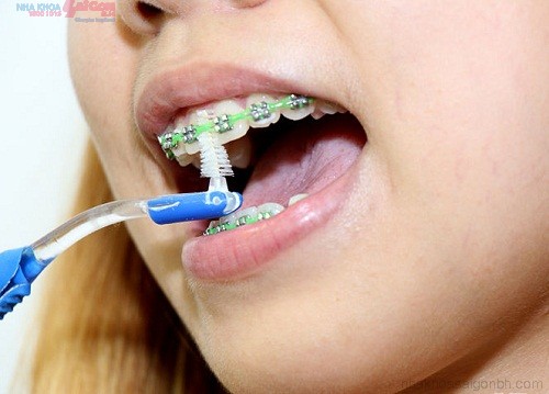 Những vật dụng cần thiết để chăm sóc răng miệng khi niềng răng