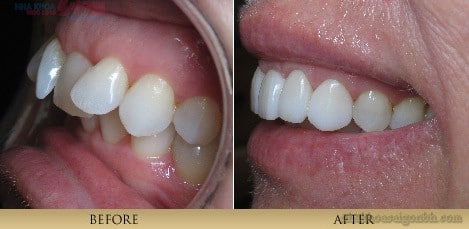 Giải pháp cho hàm răng mọc lệch, nhiễm màu
