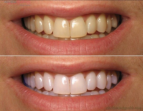 Giải pháp cho hàm răng mọc lệch, nhiễm màu