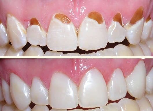 Biểu hiện và cách giảm ê buốt sau trám răng