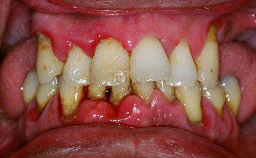 Lời khuyên khi trồng răng giả với bệnh nhân bị bệnh nha chu