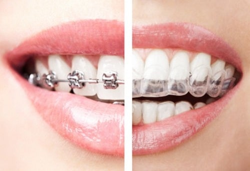 3 yếu tố ảnh hưởng đến thời gian niềng răng