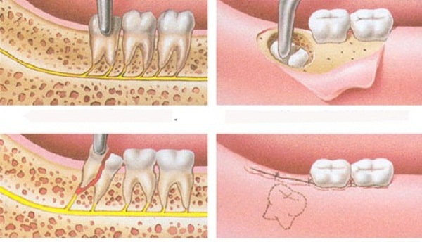 Tiểu phẫu nhổ răng khôn mọc ngầm có nguy hiểm không