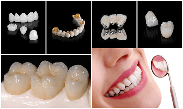 Trồng răng sứ ở đâu TPHCM thẩm mỹ nhất?
