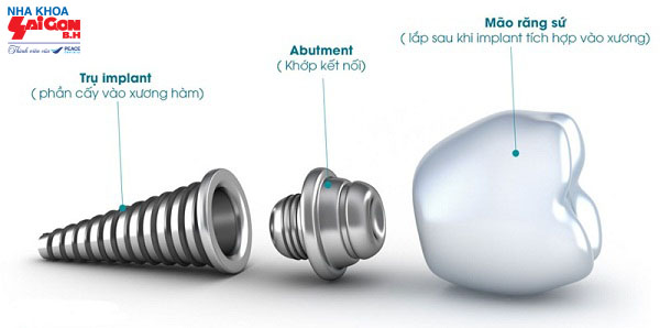 rang_implant