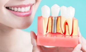 Trồng răng implant giải pháp tốt nhất bảo vệ sức khỏe răng miệng