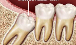 Nguyên nhân và cách điều trị sưng nướu răng trong cùng