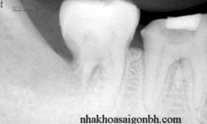 4 dấu hiệu răng khôn mọc lệch thường gặp