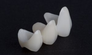 Các loại răng sứ phổ biến hiện nay là những loại nào?