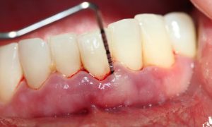 Viêm chân răng chảy máu: Nguyên nhân và cách chữa trị
