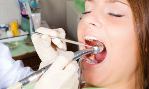 Trám răng sâu bị nhức nguyên nhân do đâu? Cách khắc phục như thế nào?