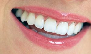 Dấu hiệu và cách điều trị bọc răng sứ bị viêm lợi